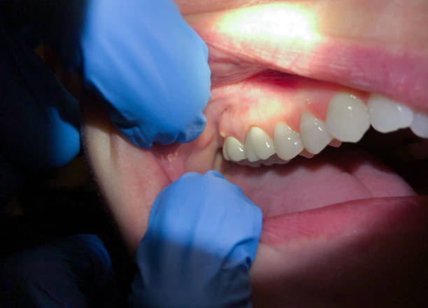 Best Emergency Tooth Extraction in Rancho Cumonga, CA